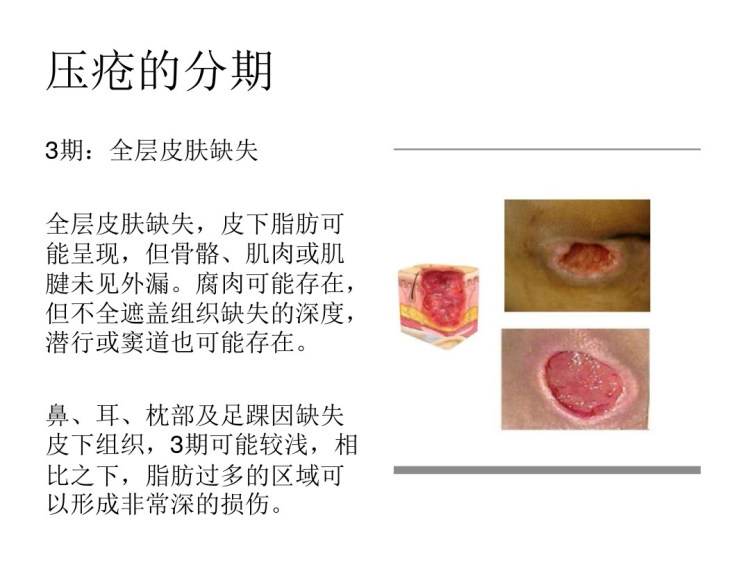 最新压疮分期与处理策略全面探讨（2017版）